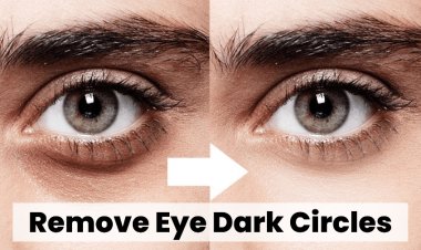 Easy Steps To Remove Your Under Eye Dark Circles Permanently