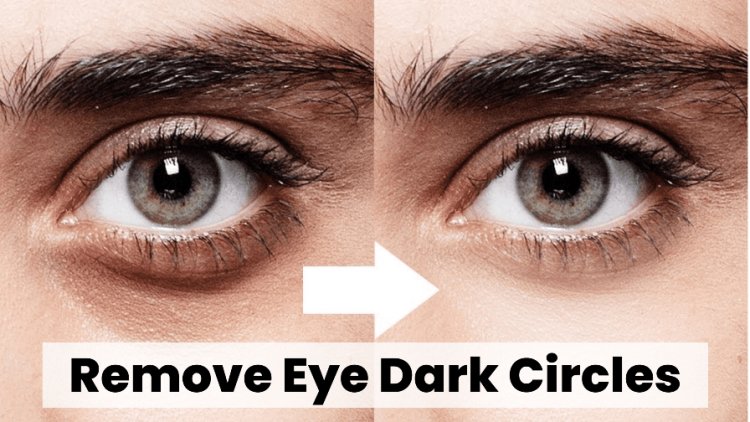 Easy Steps To Remove Your Under Eye Dark Circles Permanently
